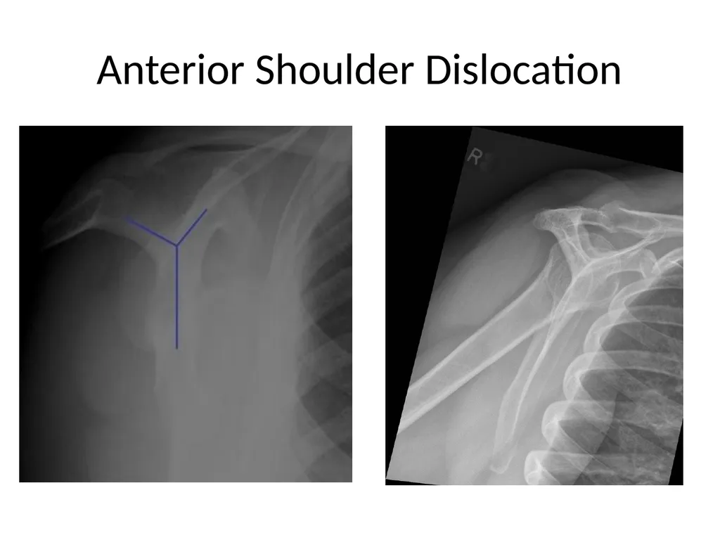Shoulder Radiography What to consider when - slide 34 of 39
