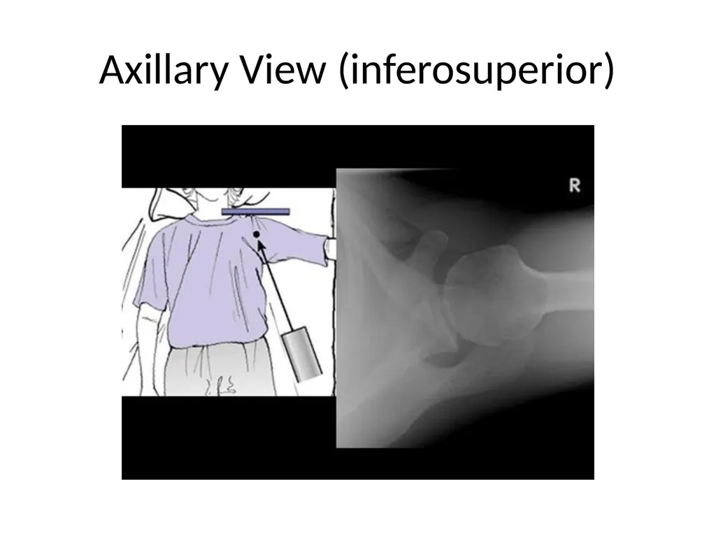 Shoulder Radiography What to consider when - slide 12 of 39