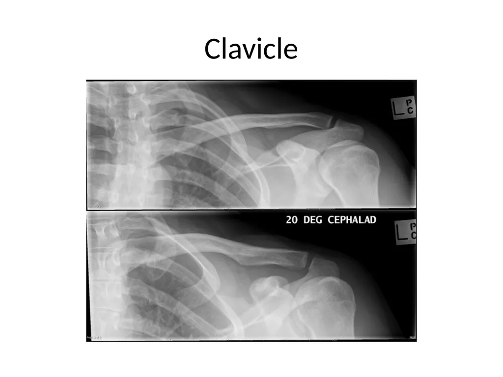 Shoulder Radiography What to consider when - slide 18 of 39