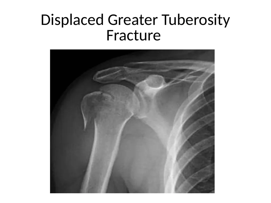 Shoulder Radiography What to consider when - slide 30 of 39