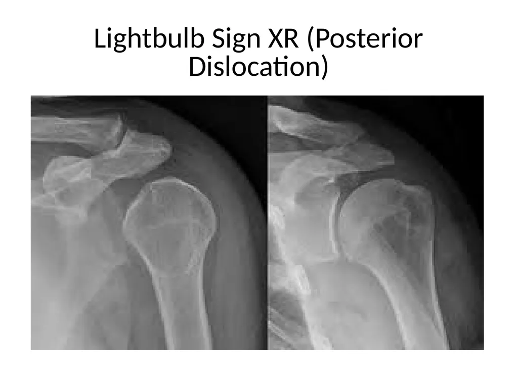 Shoulder Radiography What to consider when - slide 36 of 39