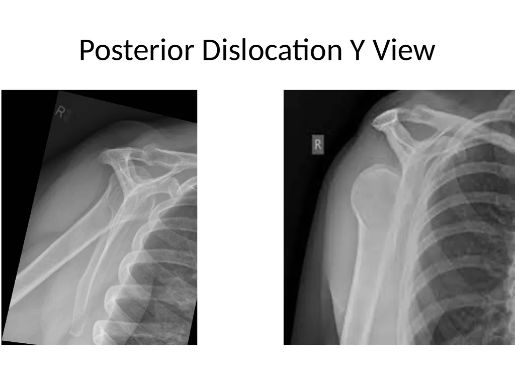 Shoulder Radiography What to consider when - slide 35 of 39