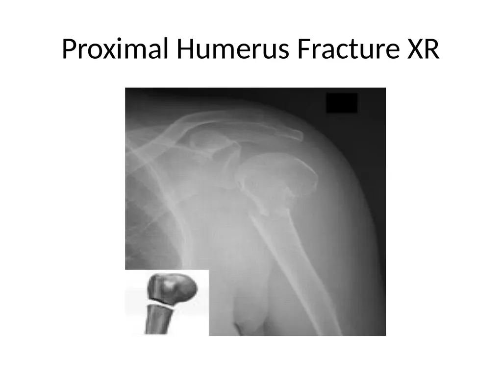 Shoulder Radiography What to consider when - slide 29 of 39