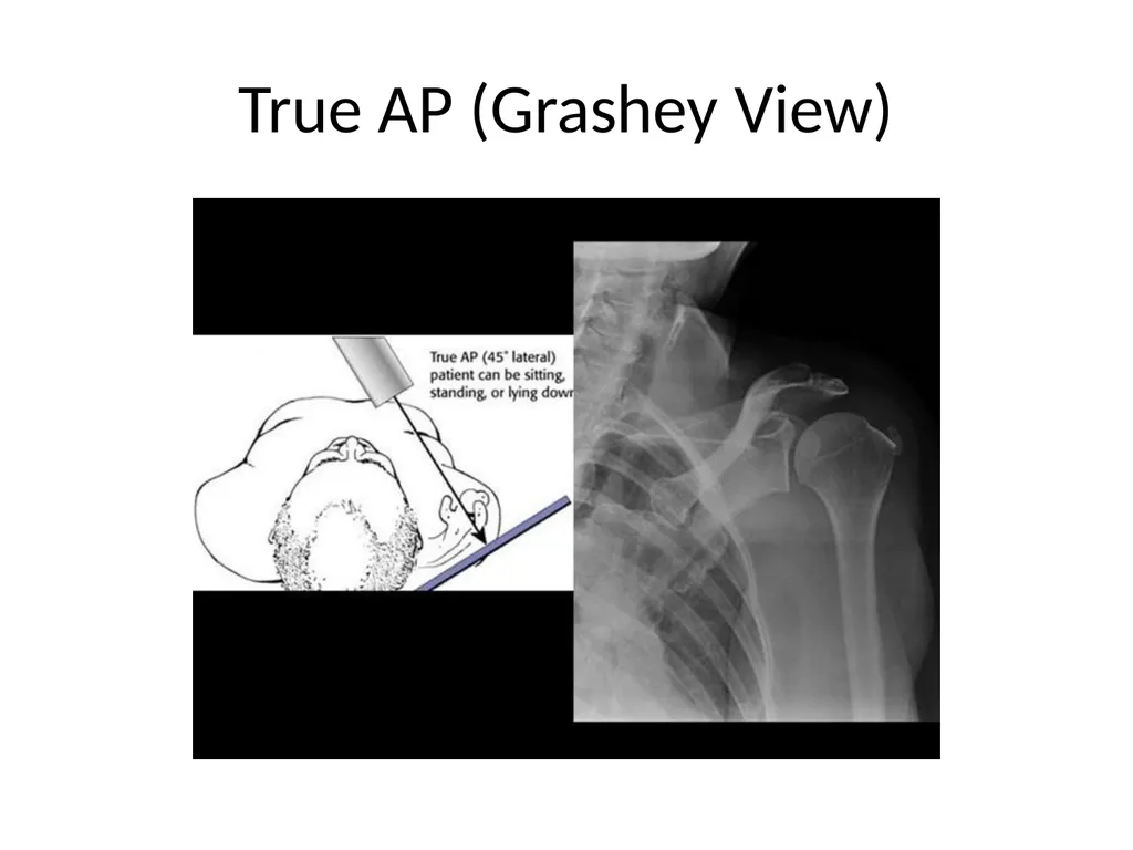 Shoulder Radiography What to consider when - slide 5 of 39