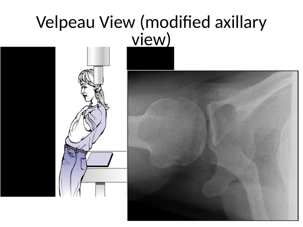 Shoulder Radiography What to consider when - slide 14 of 39