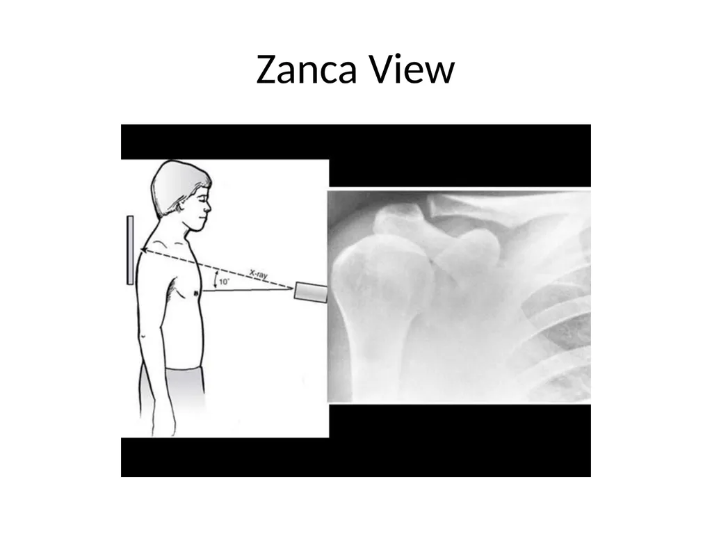 Shoulder Radiography What to consider when - slide 16 of 39