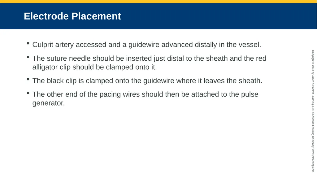 CHAPTER 17 Temporary Pacing and Cardioversion - slide 21 of 38