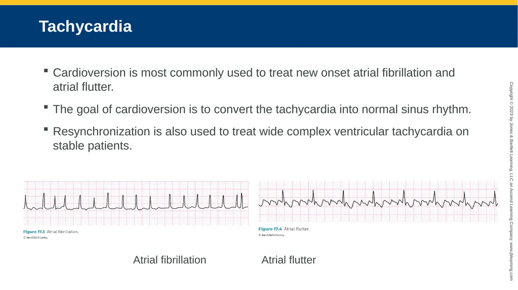 CHAPTER 17 Temporary Pacing and Cardioversion - slide 32 of 38