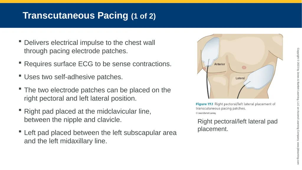 CHAPTER 17 Temporary Pacing and Cardioversion - slide 10 of 38