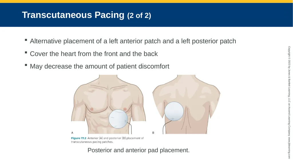 CHAPTER 17 Temporary Pacing and Cardioversion - slide 11 of 38
