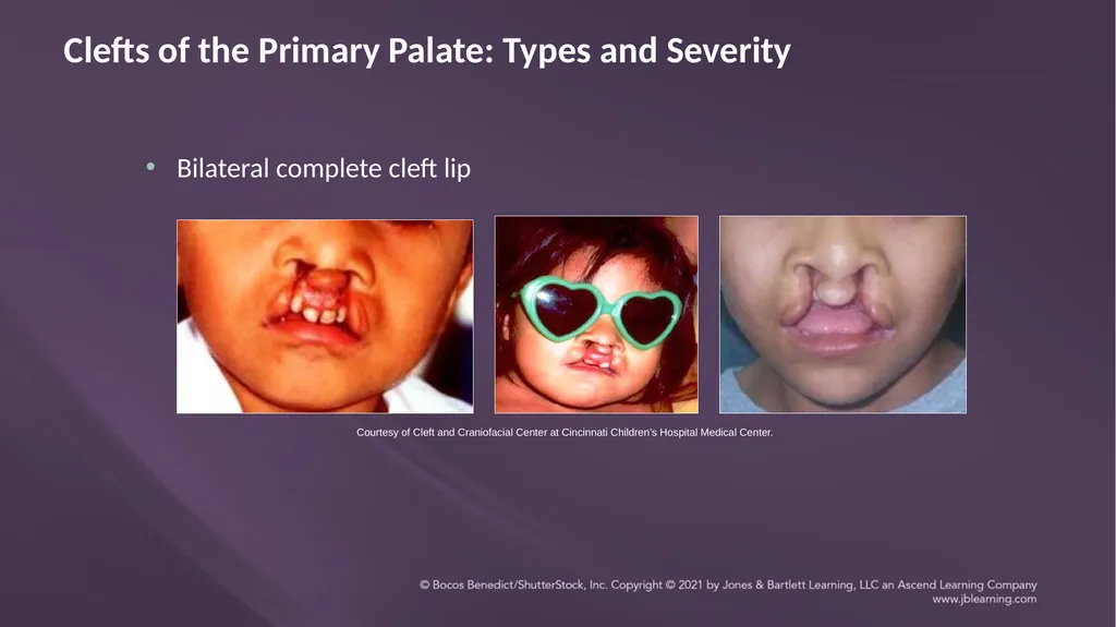 Chapter 3: Clefts of the Lip and Palate Chapter 3: - slide 31 of 64