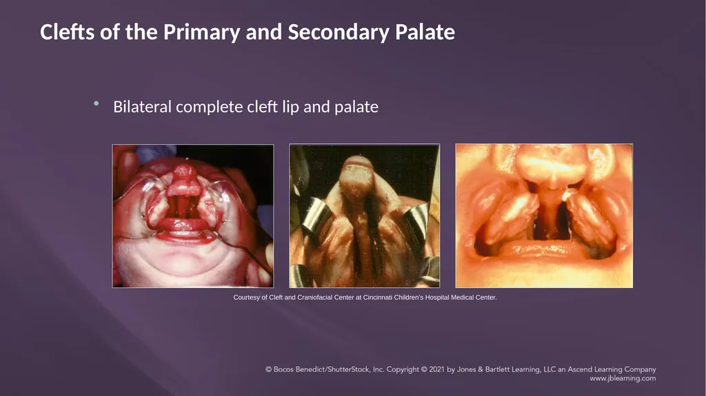 Chapter 3: Clefts of the Lip and Palate Chapter 3: - slide 39 of 64