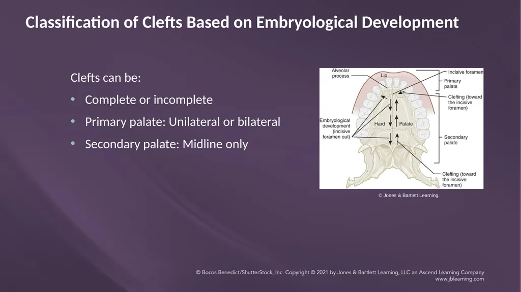 Chapter 3: Clefts of the Lip and Palate Chapter 3: - slide 14 of 64