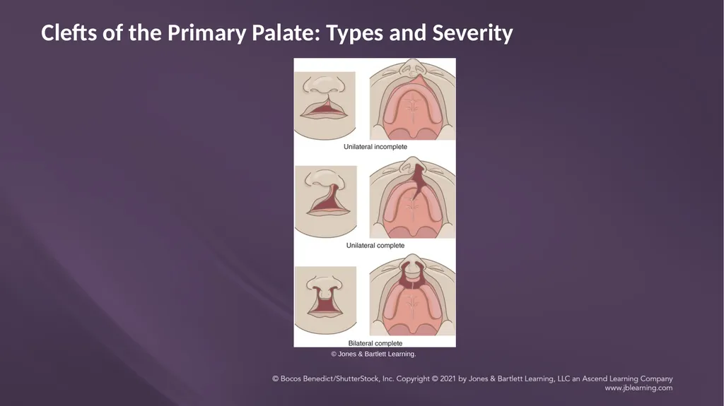 Chapter 3: Clefts of the Lip and Palate Chapter 3: - slide 23 of 64