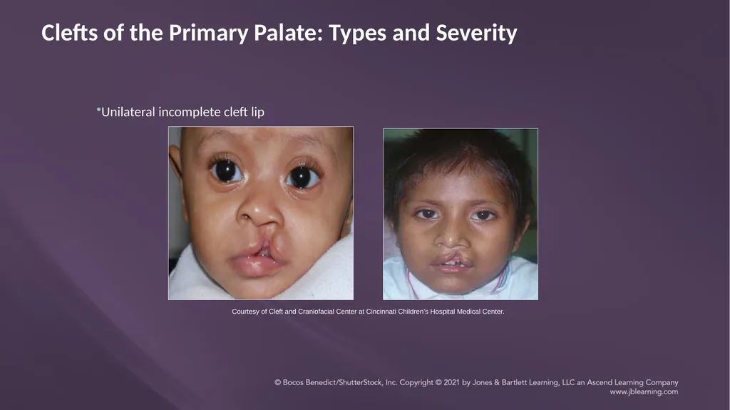 Chapter 3: Clefts of the Lip and Palate Chapter 3: - slide 26 of 64