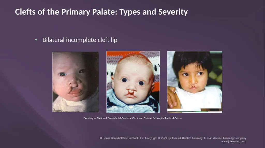 Chapter 3: Clefts of the Lip and Palate Chapter 3: - slide 27 of 64