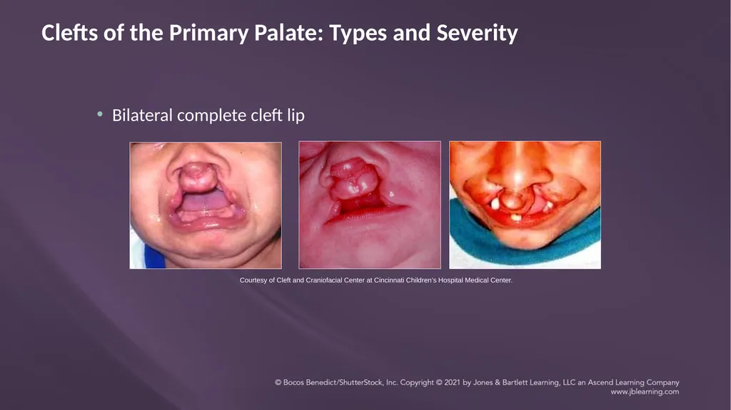 Chapter 3: Clefts of the Lip and Palate Chapter 3: - slide 32 of 64