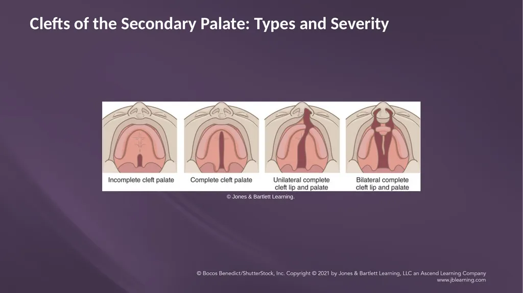 Chapter 3: Clefts of the Lip and Palate Chapter 3: - slide 35 of 64
