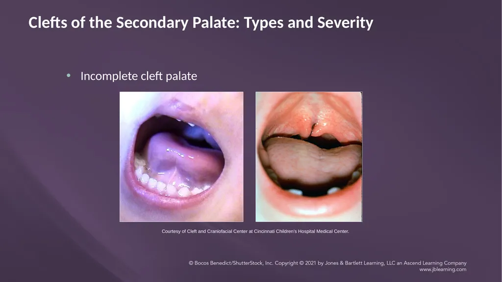 Chapter 3: Clefts of the Lip and Palate Chapter 3: - slide 36 of 64