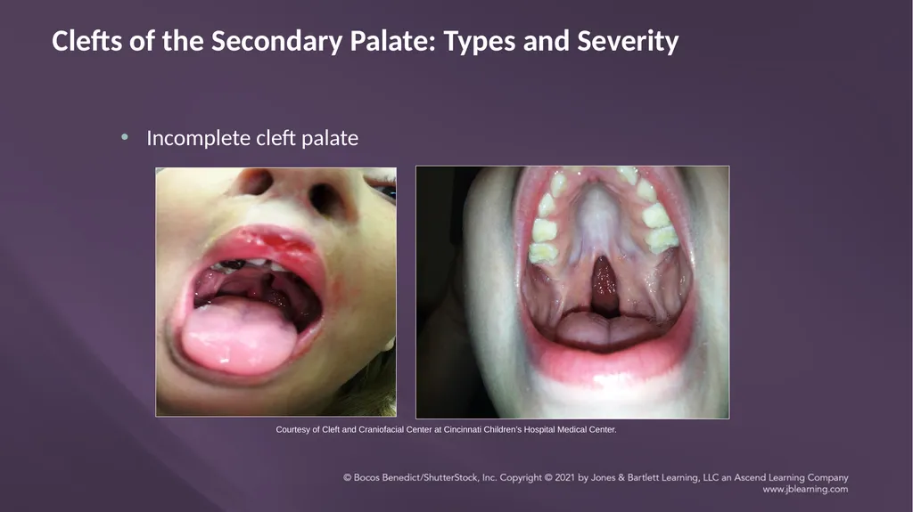 Chapter 3: Clefts of the Lip and Palate Chapter 3: - slide 37 of 64