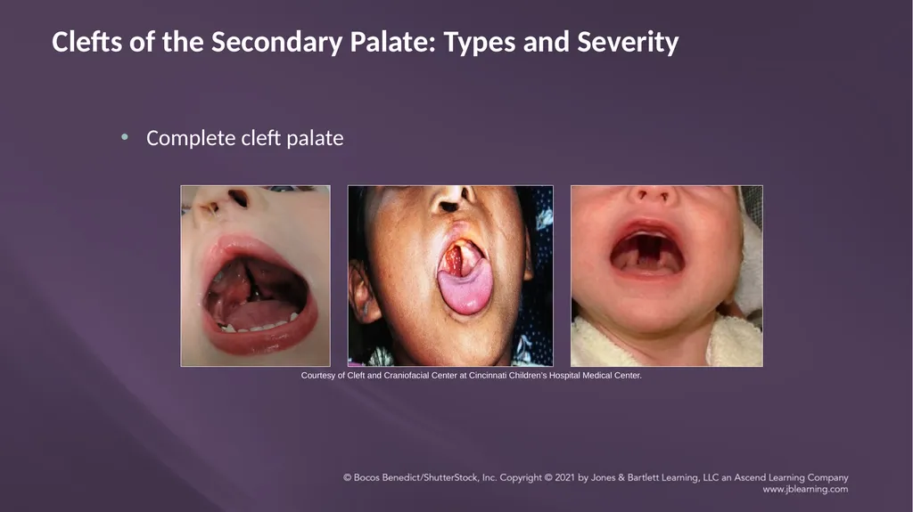 Chapter 3: Clefts of the Lip and Palate Chapter 3: - slide 38 of 64