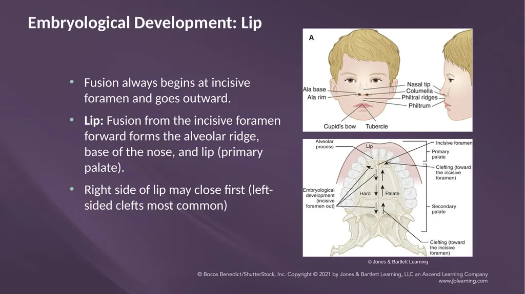 Chapter 3: Clefts of the Lip and Palate Chapter 3: - slide 6 of 64