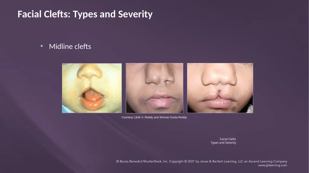 Chapter 3: Clefts of the Lip and Palate Chapter 3: - slide 55 of 64