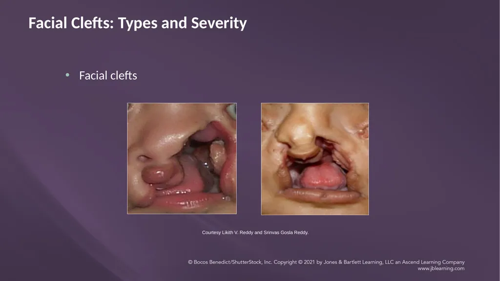 Chapter 3: Clefts of the Lip and Palate Chapter 3: - slide 57 of 64