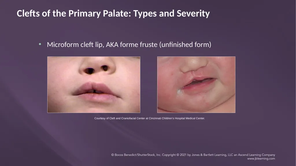 Chapter 3: Clefts of the Lip and Palate Chapter 3: - slide 24 of 64
