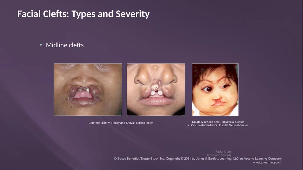 Chapter 3: Clefts of the Lip and Palate Chapter 3: - slide 56 of 64