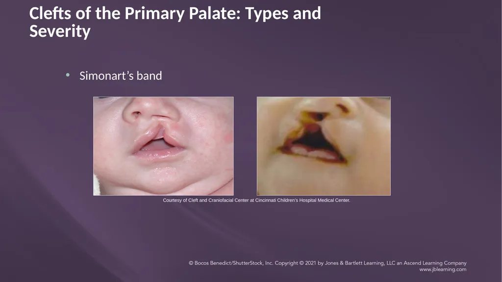 Chapter 3: Clefts of the Lip and Palate Chapter 3: - slide 25 of 64