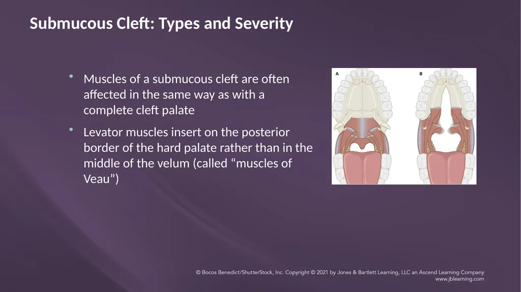 Chapter 3: Clefts of the Lip and Palate Chapter 3: - slide 45 of 64