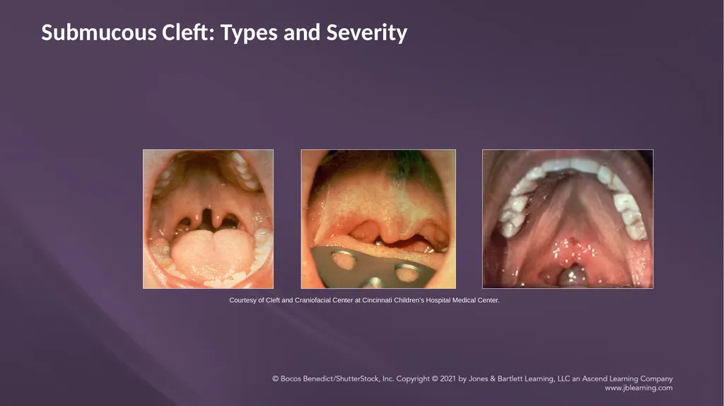 Chapter 3: Clefts of the Lip and Palate Chapter 3: - slide 46 of 64