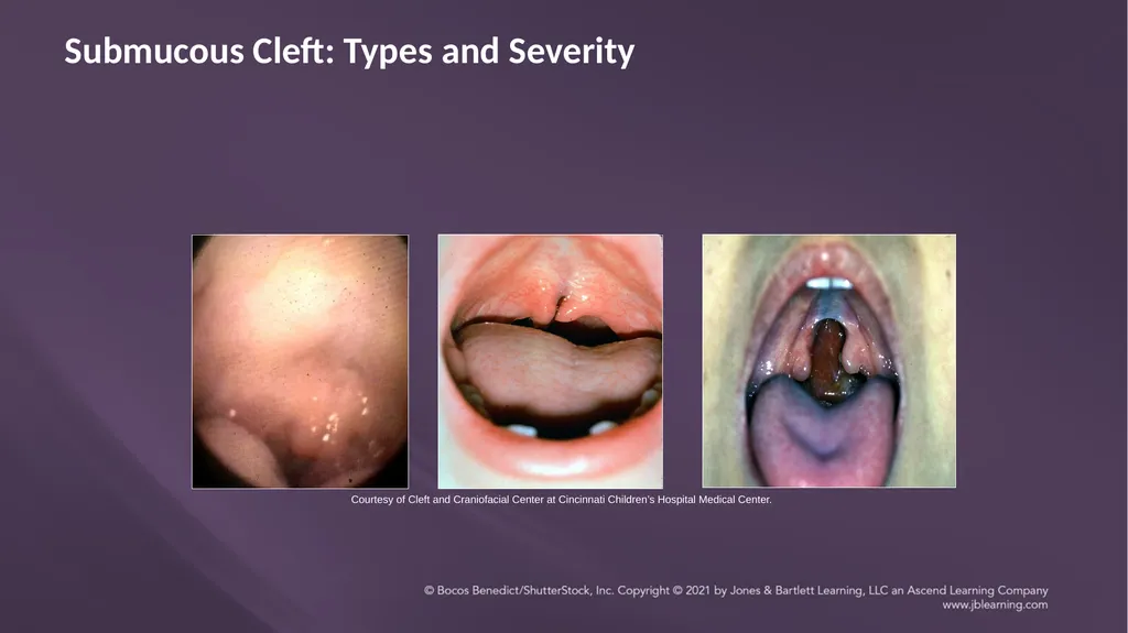 Chapter 3: Clefts of the Lip and Palate Chapter 3: - slide 47 of 64
