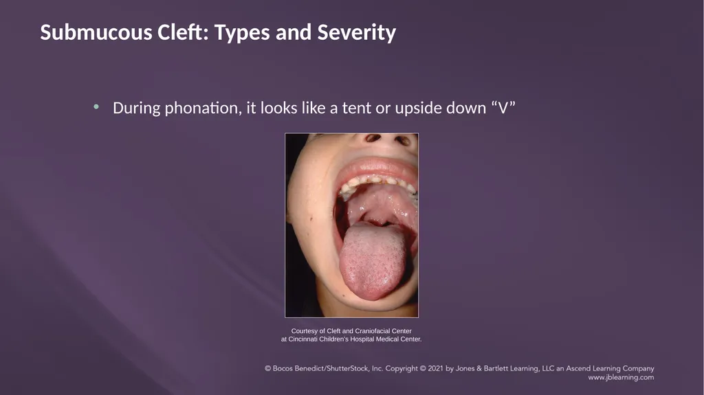 Chapter 3: Clefts of the Lip and Palate Chapter 3: - slide 48 of 64