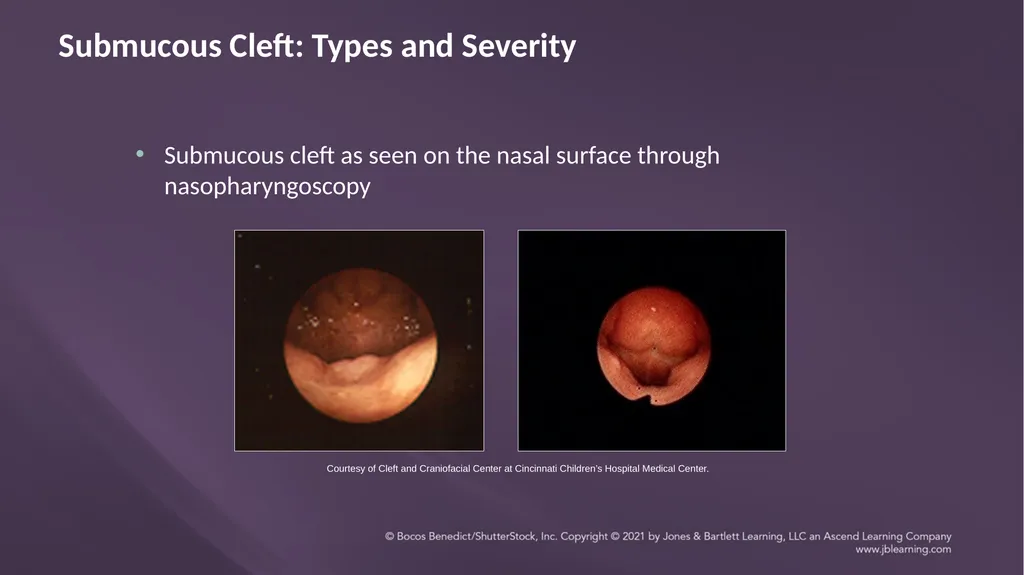 Chapter 3: Clefts of the Lip and Palate Chapter 3: - slide 49 of 64