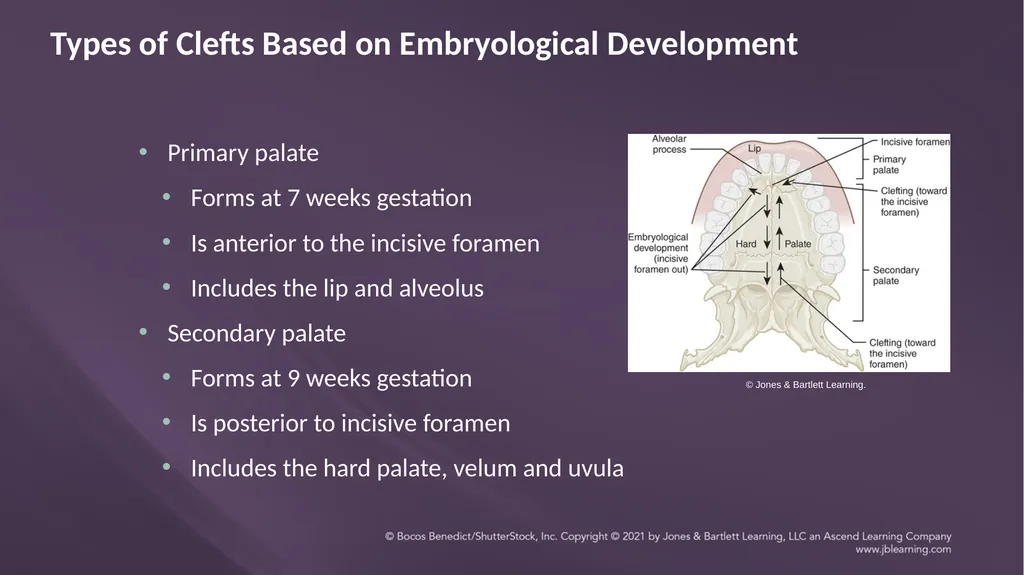 Chapter 3: Clefts of the Lip and Palate Chapter 3: - slide 13 of 64