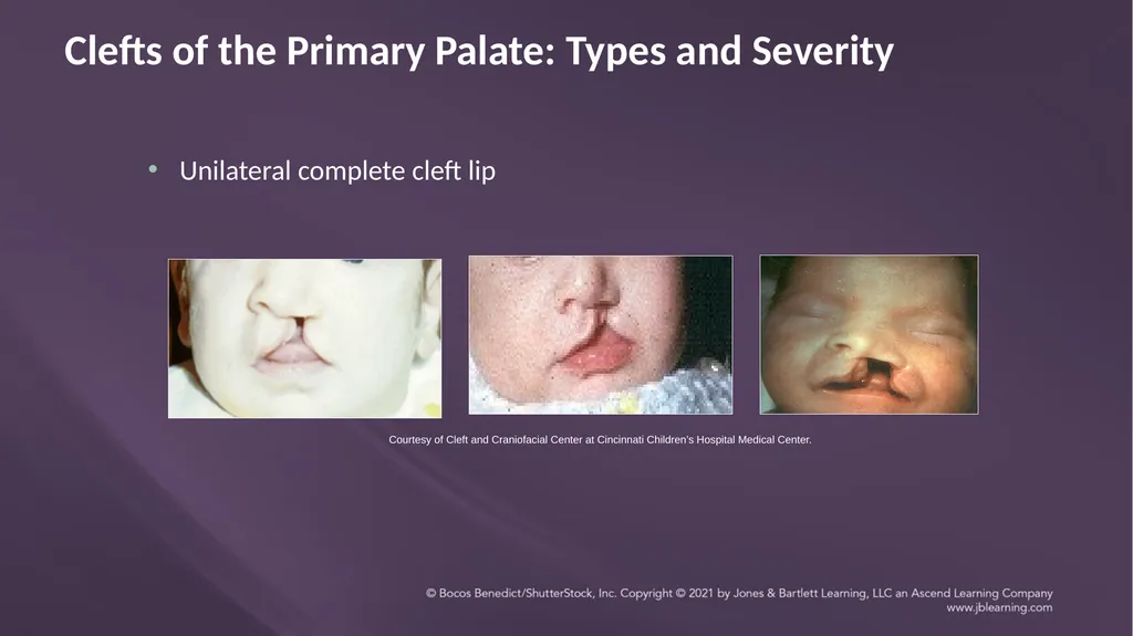 Chapter 3: Clefts of the Lip and Palate Chapter 3: - slide 28 of 64