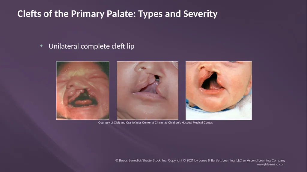 Chapter 3: Clefts of the Lip and Palate Chapter 3: - slide 29 of 64