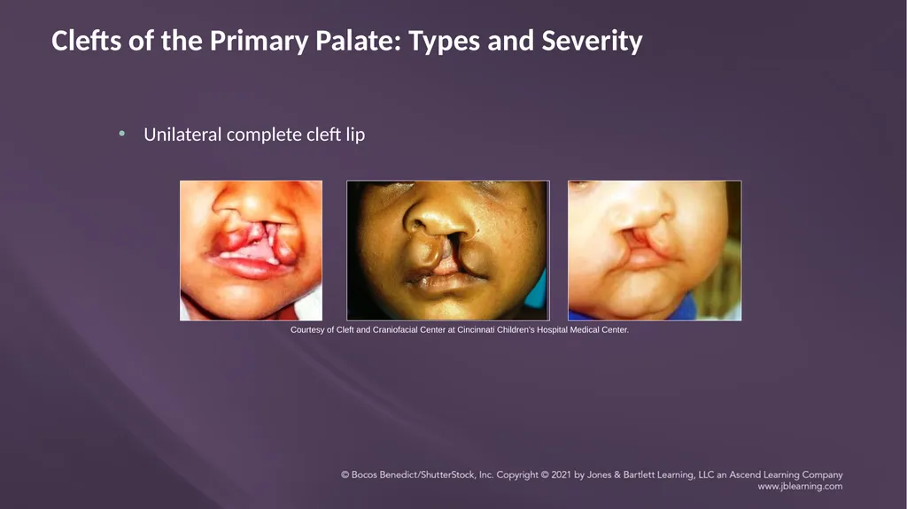 Chapter 3: Clefts of the Lip and Palate Chapter 3: - slide 30 of 64