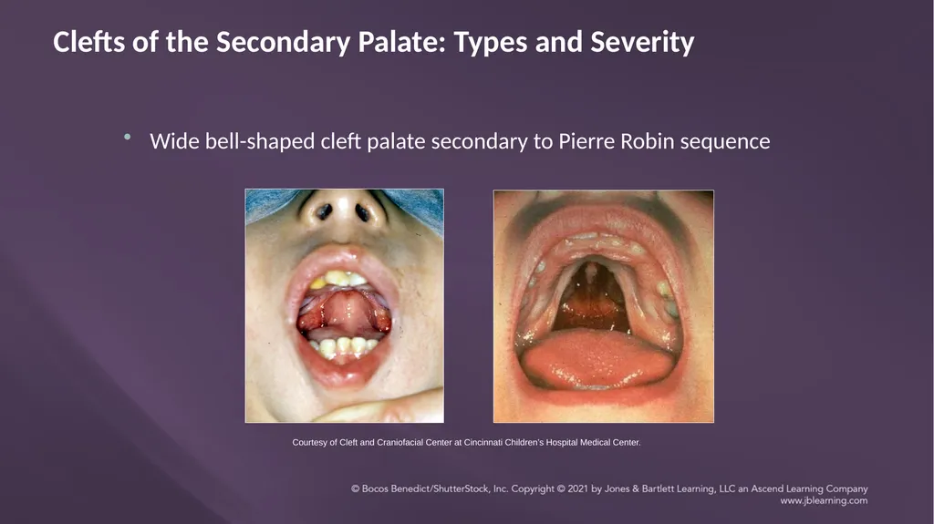 Chapter 3: Clefts of the Lip and Palate Chapter 3: - slide 40 of 64