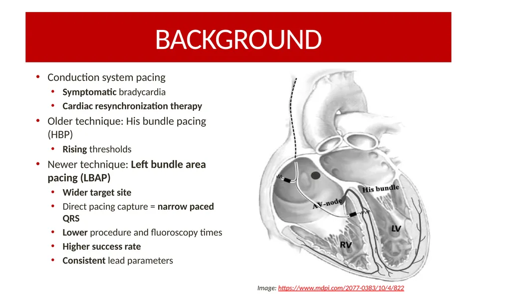 RIGHT-SIDED VS. LEFT-SIDED LEFT BUNDLE AREA LEAD - slide 2 of 12