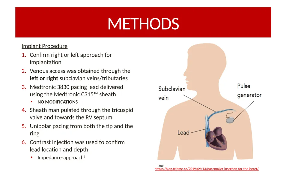 RIGHT-SIDED VS. LEFT-SIDED LEFT BUNDLE AREA LEAD - slide 5 of 12
