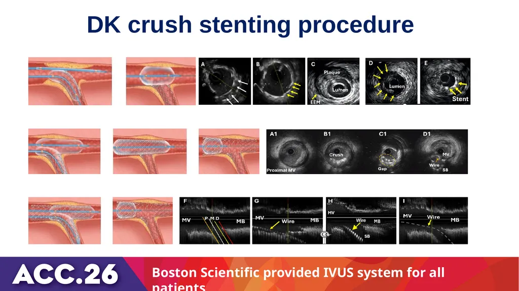 IVUS or angiography guidance for PCI in complex - slide 12 of 23