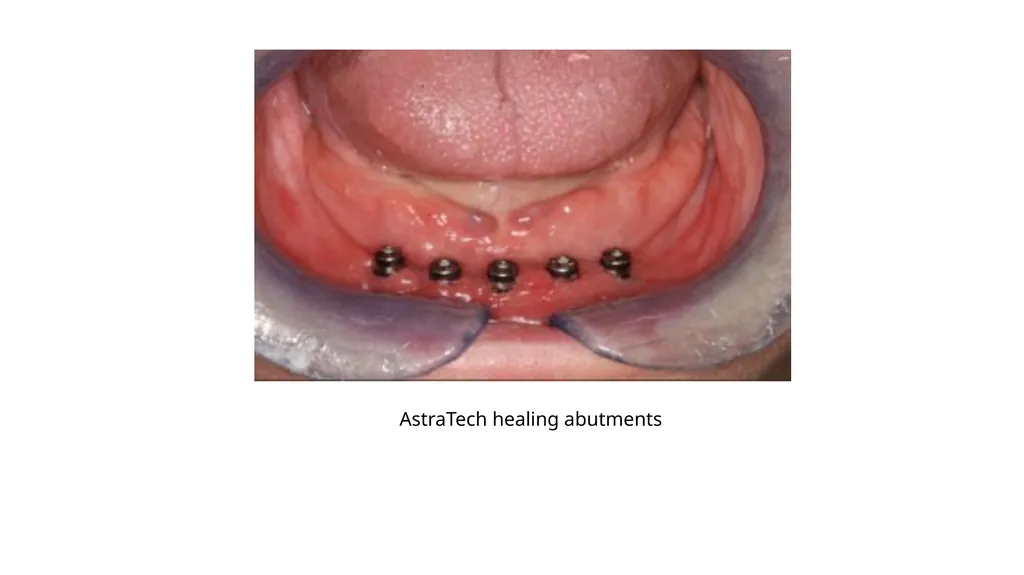 IMPRESSION IN IMPLANT DENTISTRY Presented by :Dr. - slide 12 of 38