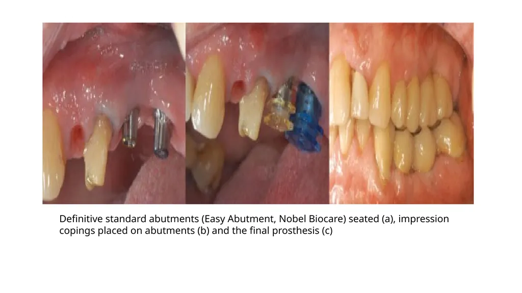 IMPRESSION IN IMPLANT DENTISTRY Presented by :Dr. - slide 19 of 38
