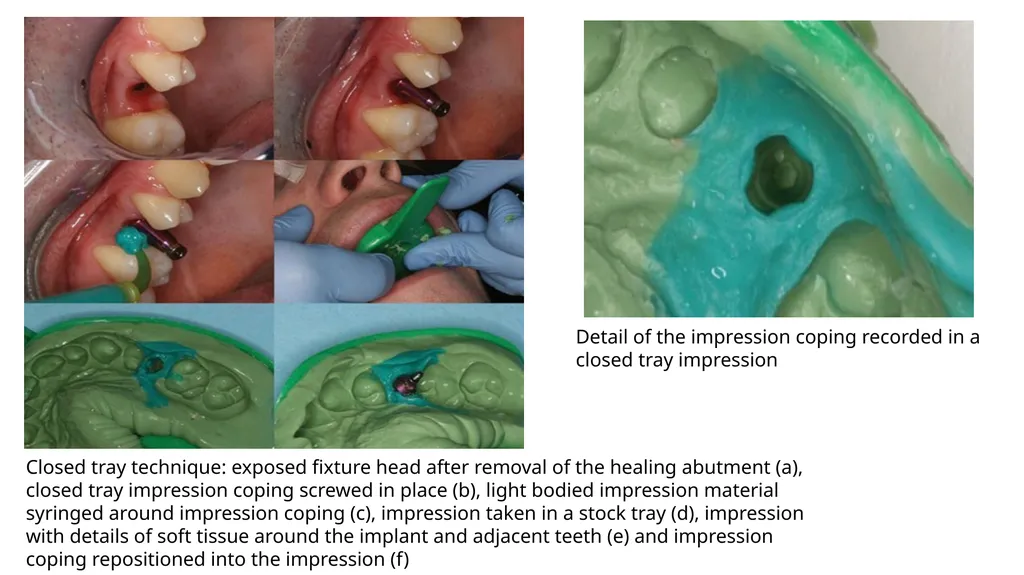 IMPRESSION IN IMPLANT DENTISTRY Presented by :Dr. - slide 26 of 38