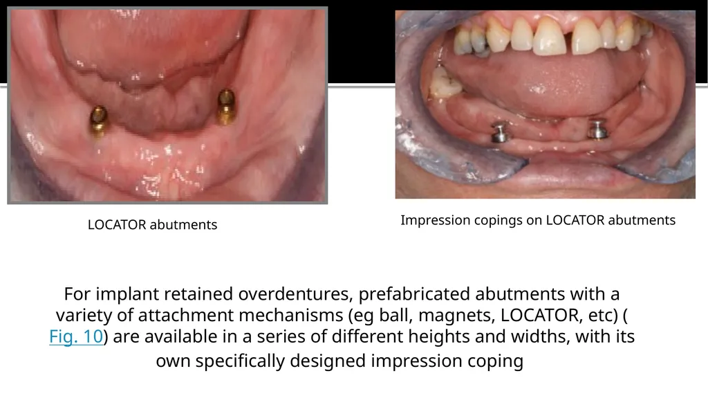 IMPRESSION IN IMPLANT DENTISTRY Presented by :Dr. - slide 20 of 38
