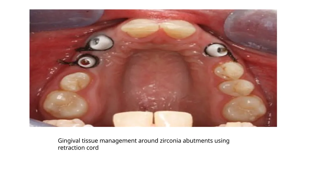 IMPRESSION IN IMPLANT DENTISTRY Presented by :Dr. - slide 32 of 38