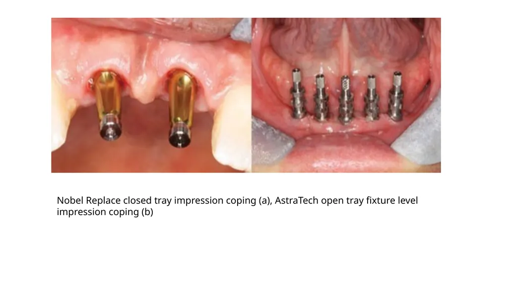 IMPRESSION IN IMPLANT DENTISTRY Presented by :Dr. - slide 14 of 38